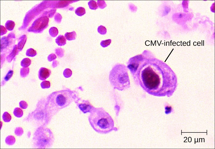 Cells infected with CMV. by Centers for Disease Control and Prevention