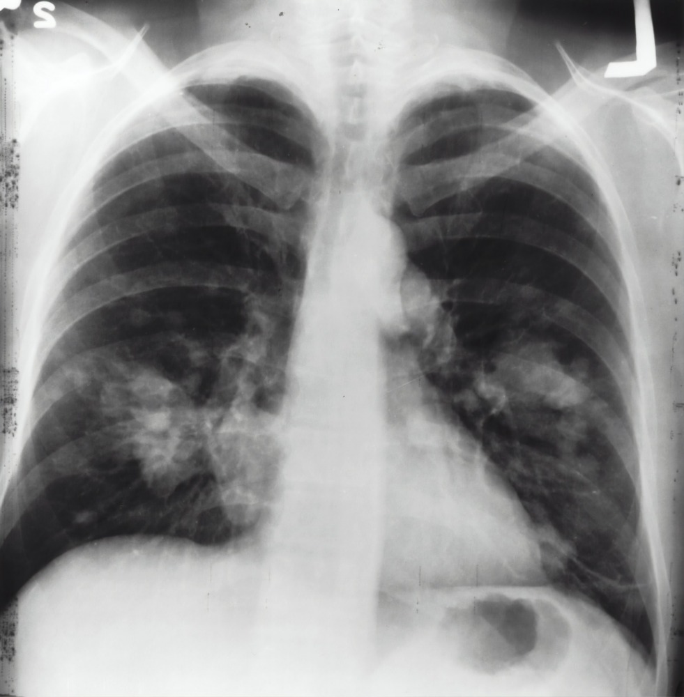 x-ray image of a chest. by the National Cancer Institute, Unsplash