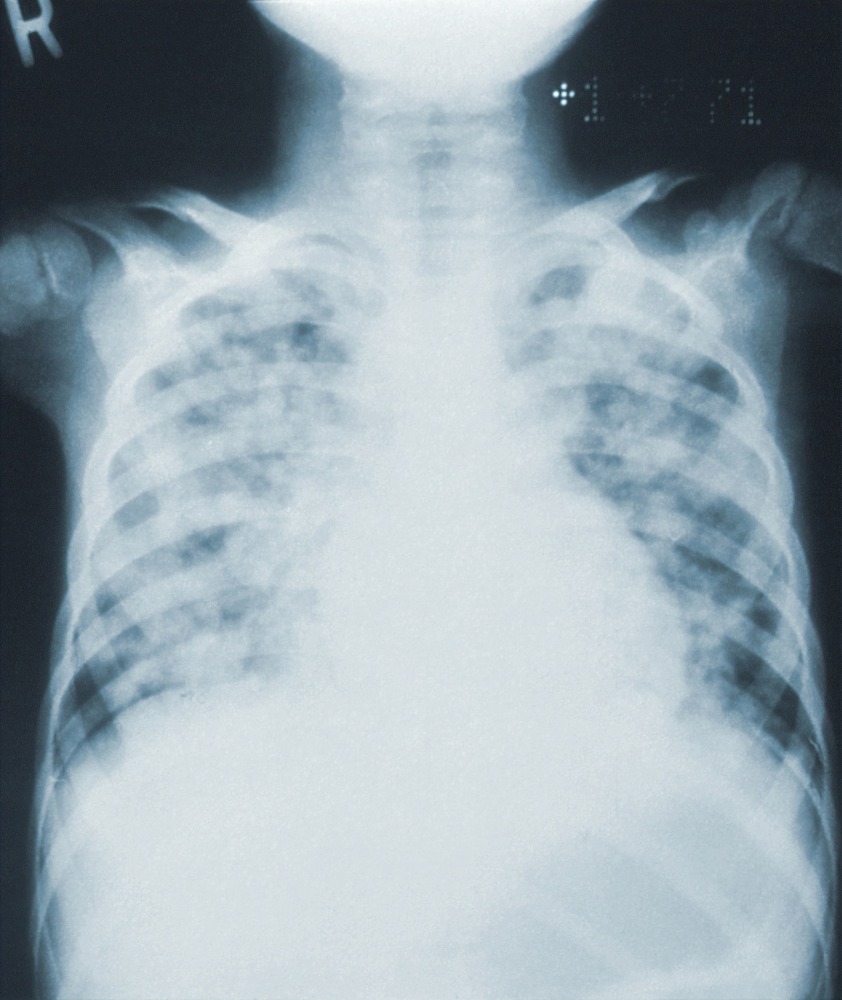 X-ray of lungs. by the CDC, unsplash