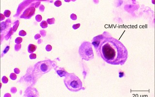 Cells infected with CMV. by Centers for Disease Control and Prevention