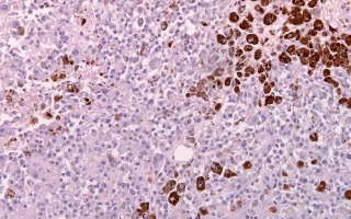 Malignant melanoma