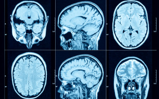 Brain CT