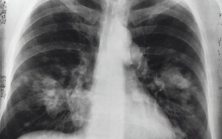 x-ray image of a chest. by the National Cancer Institute, Unsplash