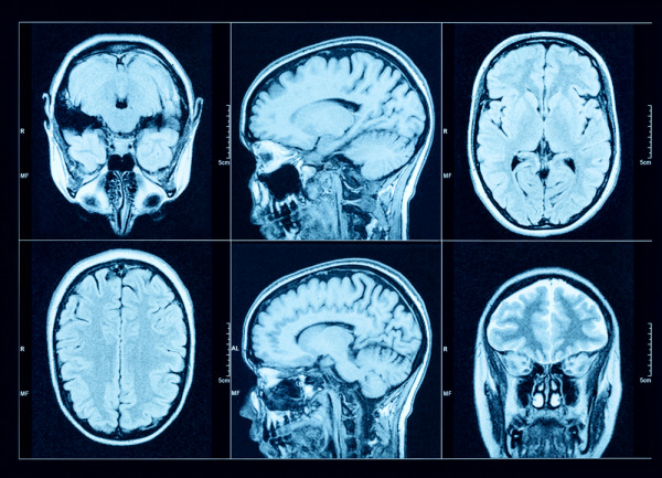Brain CT