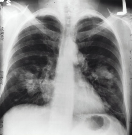 x-ray image of a chest. by the National Cancer Institute, Unsplash